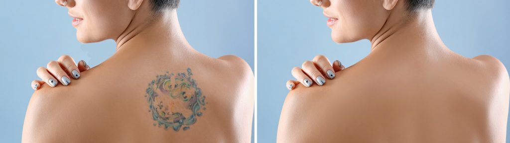 Tattoo Removal: Alternative Methods