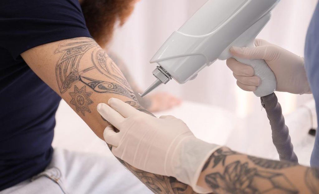 Removing the Painful Scars Using Laser Tattoo Removal